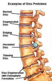 Lumbar Spine Laminectomy Surgery India,Spine Surgeons India