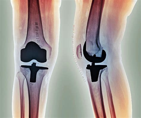 Anatomy Of Total Knee Replacement