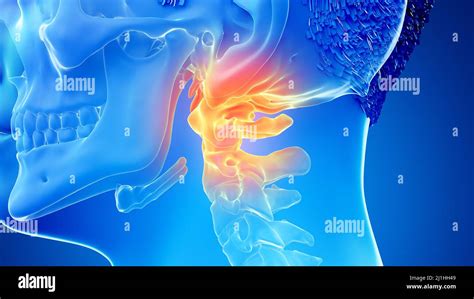 Painful atlas bone, illustration Stock Photo - Alamy