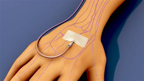 Foley Catheter Stock Video Footage - 4K and HD Video Clips | Shutterstock