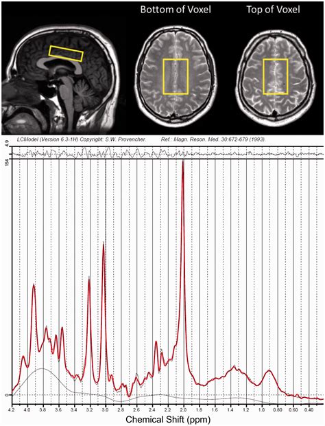 Magnetic Resonance Spectroscopy Evidence For Declining Gliosis In Ms