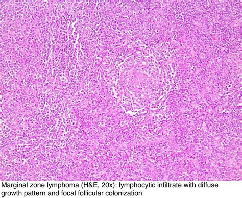 Pathology Outlines Lymphoma