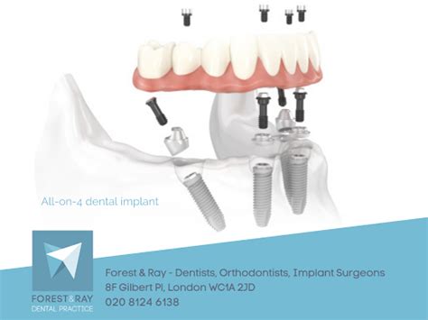 𝐀𝐥𝐥 𝐨𝐧 𝟒 𝐃𝐞𝐧𝐭𝐮𝐫𝐞𝐬 𝐢𝐧 𝐂𝐞𝐧𝐭𝐫𝐚𝐥 𝐋𝐨𝐧𝐝𝐨𝐧 🦷 𝐅𝐨𝐫𝐞𝐬𝐭 And 𝐑𝐚𝐲 😊 𝐃𝐞𝐧𝐭𝐢𝐬𝐭𝐬 𝐎𝐫𝐭𝐡𝐨𝐝𝐨𝐧𝐭𝐢𝐬𝐭𝐬 𝐈𝐦𝐩𝐥𝐚𝐧𝐭 𝐒𝐮𝐫𝐠𝐞𝐨𝐧𝐬