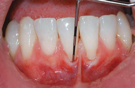 Periodontal Charting