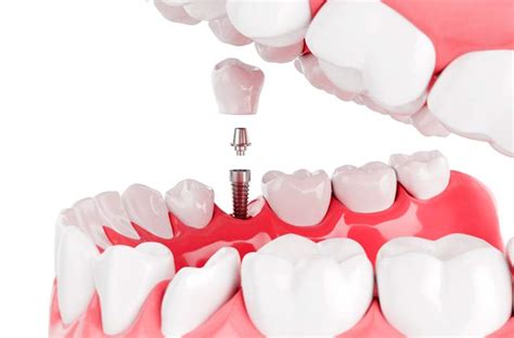 Mejores Implantes Dentales Sevilla Cl Nica Dental Esther Aparicio