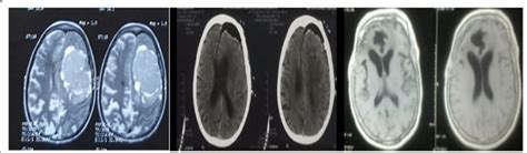 Left convexity meningioma. Left, preoperative axial MRI TII. Middle, CT... | Download Scientific ...