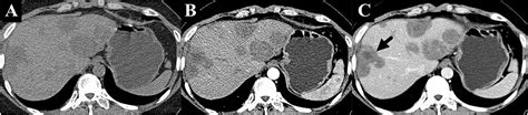 Frontiers Case Report Successful Treatment With The Combined Therapy