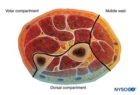 Compartment Syndrome Finger