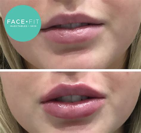 Lip Injections Before and After - Face Fit