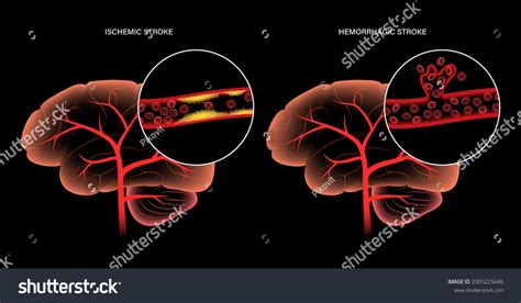 Brain Stroke Hemorrhagic Ischemic Problem Arteriosclerosis Stock Vector