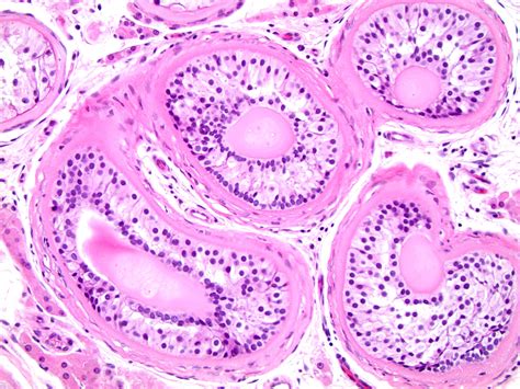 Pathology Outlines Cryptorchidism