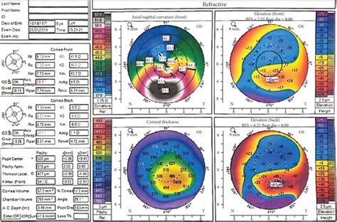 Corneal topography of the right eye with subclinical keratoconus (a ...