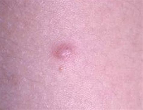 Dermatofibroma - Pictures, Causes, Removal, Treatment