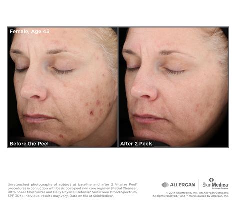 Chemical Peels Damascus Dermatology And Skin Surgery And Cosmetic Center Maryland Virginia