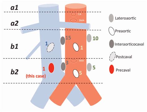 Anatomical Location Of Paraaortic Lymph Nodes With Metastasis Based On