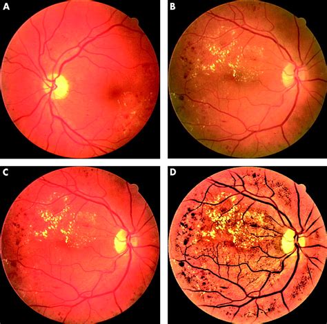 Automated Identification Of Diabetic Retinal Exudates In Digital Colour Images British Journal