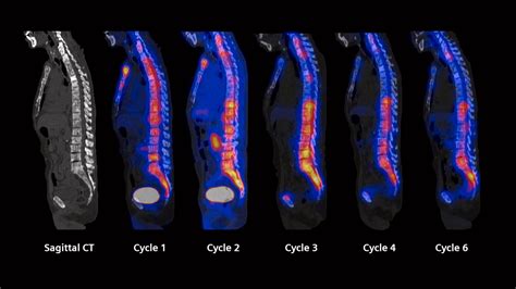 Fast Quantitative SPECT CT Acquisition Following Multiple Therapy