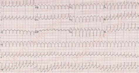 Atrial Flutter With 1 1 Conduction ECG Learn The Heart