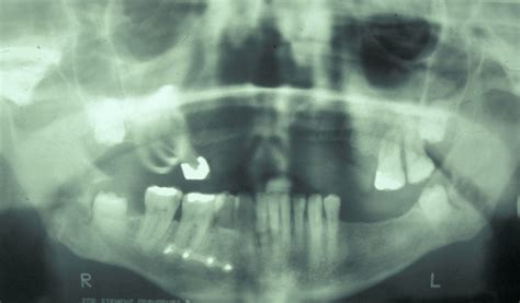 Mandibular Fracture X Ray