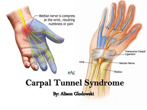 Carpal Tunnel Syndrome Hand Diagram