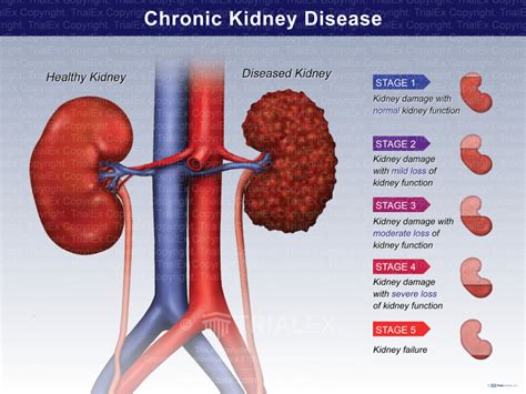 Chronic Kidney Disease Trialquest Inc