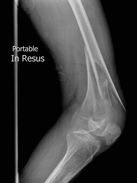 Knee Radiograph An Approach Radiology Reference Article