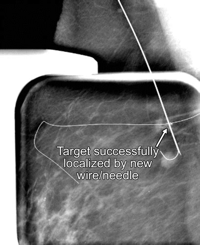 The Wire And Beyond Recent Advances In Breast Imaging Preoperative Needle Localization