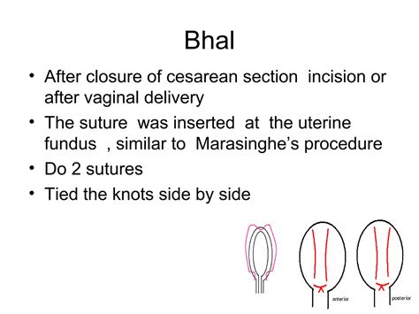 Uterine Compression Sutures Ppt