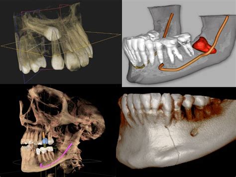 Cone Beam Computed Tomography 3D CBCT Phan Endodontic Partners