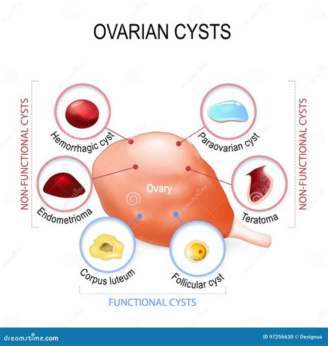 Cysts Cartoons, Illustrations & Vector Stock Images - 148 Pictures to