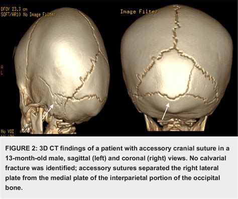 Figure 1 From Imaging Findings In Pediatric Accessory Cranial Sutures