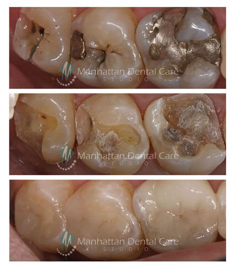 Before and After Onlay - Manhattan Dental Care Studio