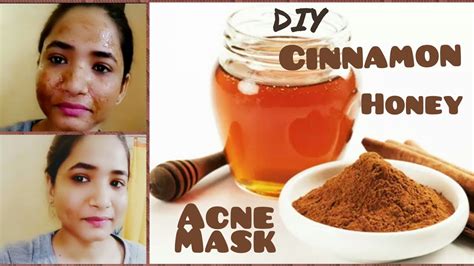 Diy Cinnamon Honey Acne Face Mask सबसे असरदार दालचीनी शहद पिपंल फेस