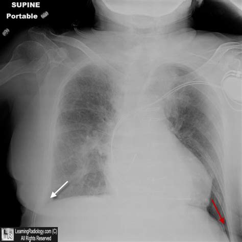 Learning Radiology Deep Sulcus Sign Pneumothorax