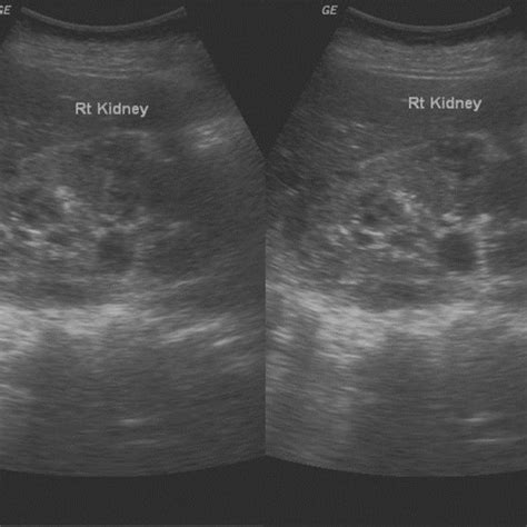 Ultrasonography Showing Medullary Nephrocalcinosis Download