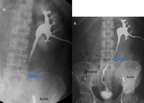 Long Term Outcome Of Yang Monti Ileal Replacement Of The Ureter A