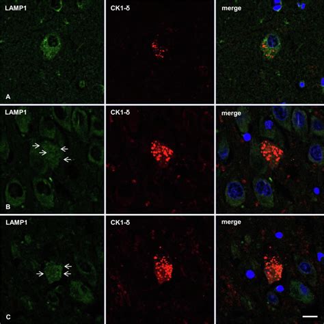 Dysregulated Protein Phosphorylation As Main Contributor Of