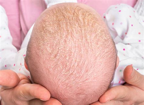 Cradle Cap Symptoms Causes Treatments And Complications Healthdirect