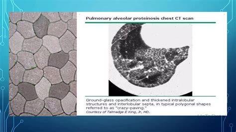 pulmonary alveolar proteinosis.pptx