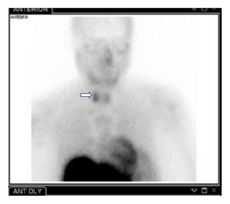 Radionuclide Parathyroid Imaging Using Technetium Tc M Sestamibi