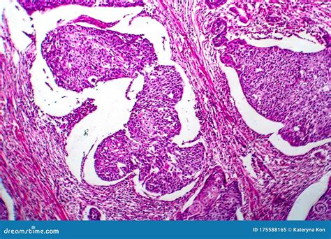 Carcinoma De C Lulas Escamosas De La Micrograf A De La Luz Del Tero