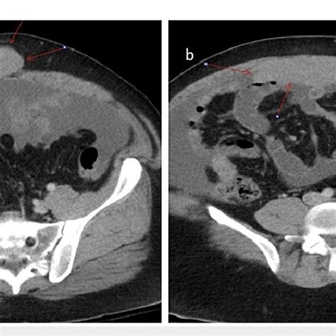 A Axial Section Of Ct Abdomen Pelvis With Contrast Showing Mass In Download Scientific