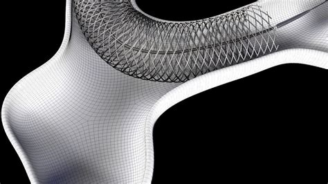 Flow diverter stent in aneurysm 3D model | CGTrader