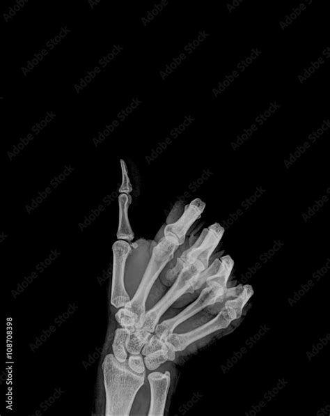 Human hand x-ray - Medical Image. Stock Photo | Adobe Stock