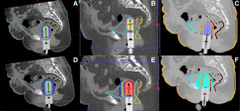 Dosimetric Comparison Of Vaginal Vault Brachytherapy Vs Applicator Guided Stereotactic Body