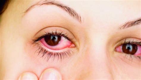 Conjuntivitis infecciosas bacterial y viral síntomas causas y