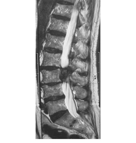 Case 2 Sagittal Preoperative T2 Mri Sequence Download Scientific Diagram