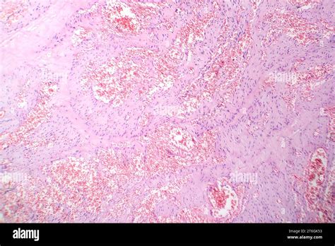 Photomicrograph Of Capillary Hemangioma Illustrating Abnormal