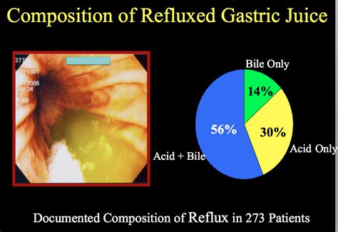 LPR - "Silent Reflux" - Virginia Heartburn and Hernia Institute