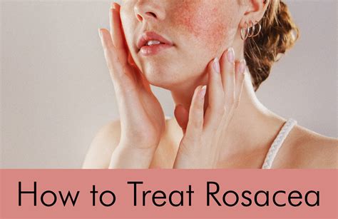 How Do You Treat Rosacea Complexion Medical Laser Clinic